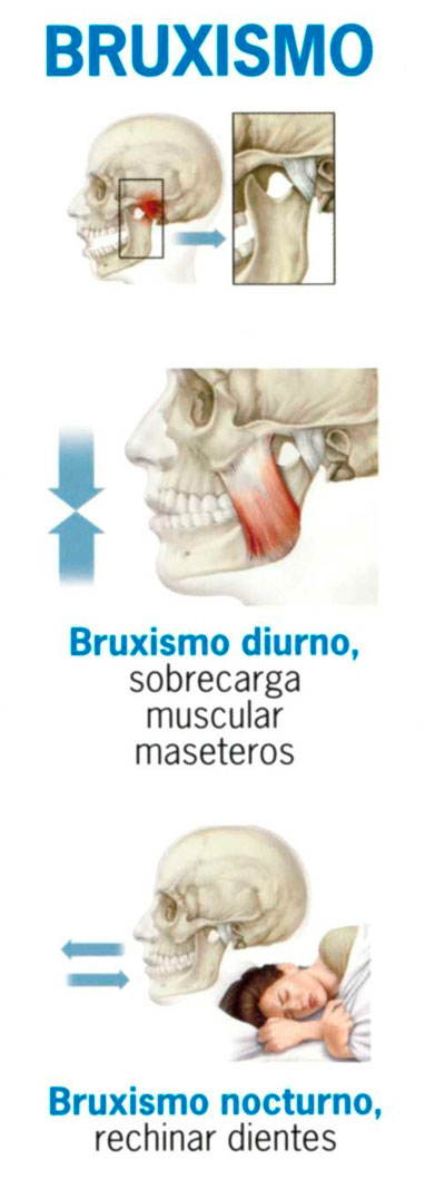 Qué es y cómo debe utilizarse la férula de descarga para el bruxismo?